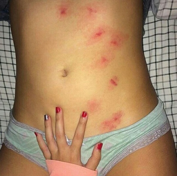 Hickey hay hickey kiss là thuật ngữ được dùng để mô tả nụ hôn