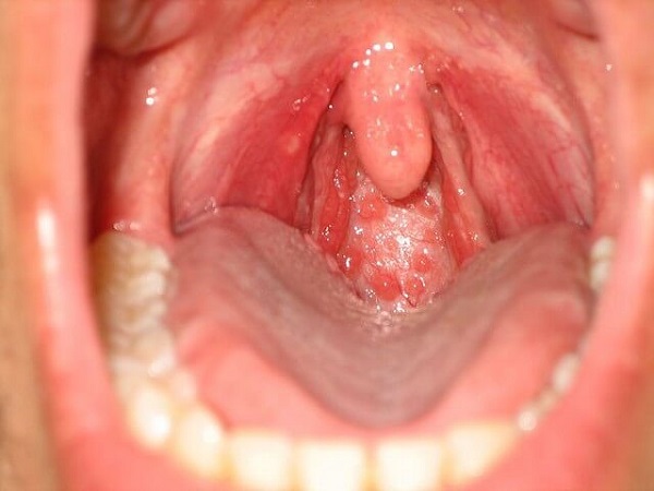 Miệng và vòm họng dễ dàng bị virus xâm nhập khi quan hệ CIA