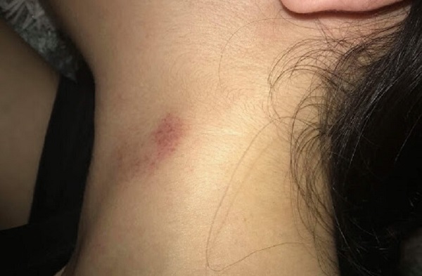 Bật mí cách hôn hickey tạo cảm giác lâng lâng và vi diệu