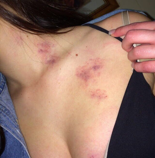 Ngụy trang để xóa vết Hickeys