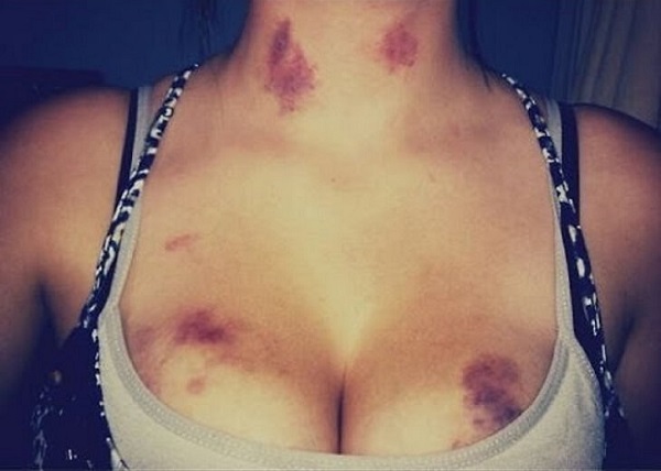 Hickey kiss, hay cách hôn hickey