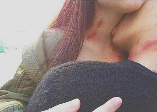 Cách hickey phê cho nam nữ