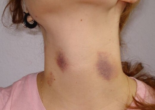 Hickey kiss được viết tắt Hickey là hôn để lại dấu ấn