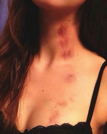 Hickey là gì? Cách tạo hickey kiss trên cơ thể người ấy.