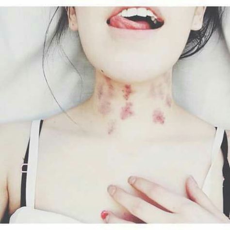 Hôn Hickey Là Gì?