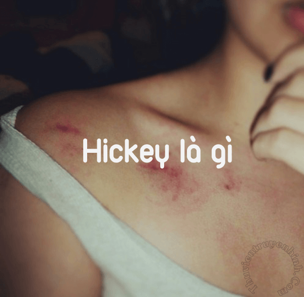 Hickey kiss là gì? Cách tạo hickey và xóa hickey như nào?