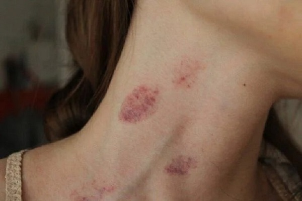Cách tạo Hickey có nguy hiểm không