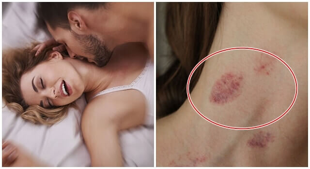 Hickey kiss được viết tắt Hickey là hôn để lại dấu ấn
